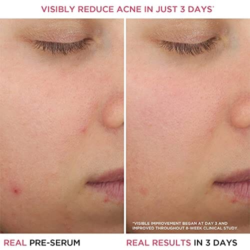 مصل معالجة حب الشباب بحمض الساليسيليك  IT Cosmetics Bye Bye Breakout 2% Salicylic Acid Acne Treatment Serum, Helps Reduce Pimples in 3 Days & Fades Look of Post-Acne Marks in 8 Weeks, Facial Skin Care Product with 3% Lactic Acid - 1 fl oz