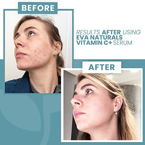 مصل إيفا ناتشورالز فيتامين سي للوجه Eva Naturals Vitamin C Serum for Face Plus Hyaluronic Acid, Retinol, Niacinamide & Salicylic Acid, Anti Aging Serum, Reduce Fine Lines, Wrinkles & Dark Spots, Brightening Skin Serum for Glowing Skin (1 oz)