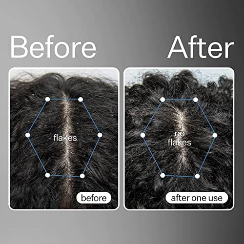 زيت إزالة السموم من فروة الرأس بفيتامين هـ  Act+Acre Cold Processed Vitamin E Scalp Detox Oil - Sulfate Free Scalp Care with Oil for Dandruff and Dry Itchy Scalp - Hair Growth Treatment for Thinning Hair (3 Fluid Ounces)