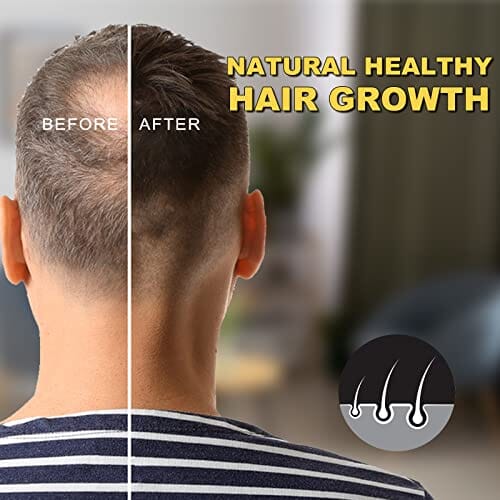 مينوكسيديل سيروم بيوتين لنمو الشعر Minoxidil for Men and Women - Biotin Hair Growth Serum & 5% Minoxidil Treatment for Stronger Thicker Longer Hair – Natural Hair Growth Thickening Treatment - Stop Thinning & Hair Loss -1-Month supply