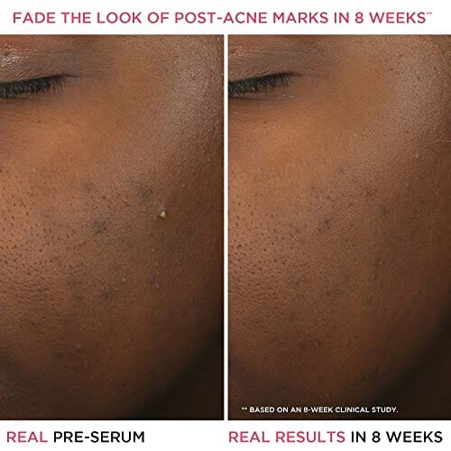 مصل معالجة حب الشباب بحمض الساليسيليك  IT Cosmetics Bye Bye Breakout 2% Salicylic Acid Acne Treatment Serum, Helps Reduce Pimples in 3 Days & Fades Look of Post-Acne Marks in 8 Weeks, Facial Skin Care Product with 3% Lactic Acid - 1 fl oz