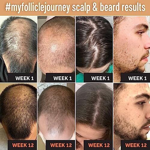 غسول مينوكسيديل للرجال والنساء % Minoxidil for Men and Women Lotion - 1 Month - Hair Growth Topical for Scalp and Beard with Biotin, Caffeine and Niacinamide - Hair Regrowth Treatment For Stronger, Thicker Longer Hair